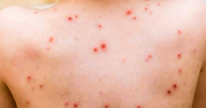 measles-puerto-vallarta-1